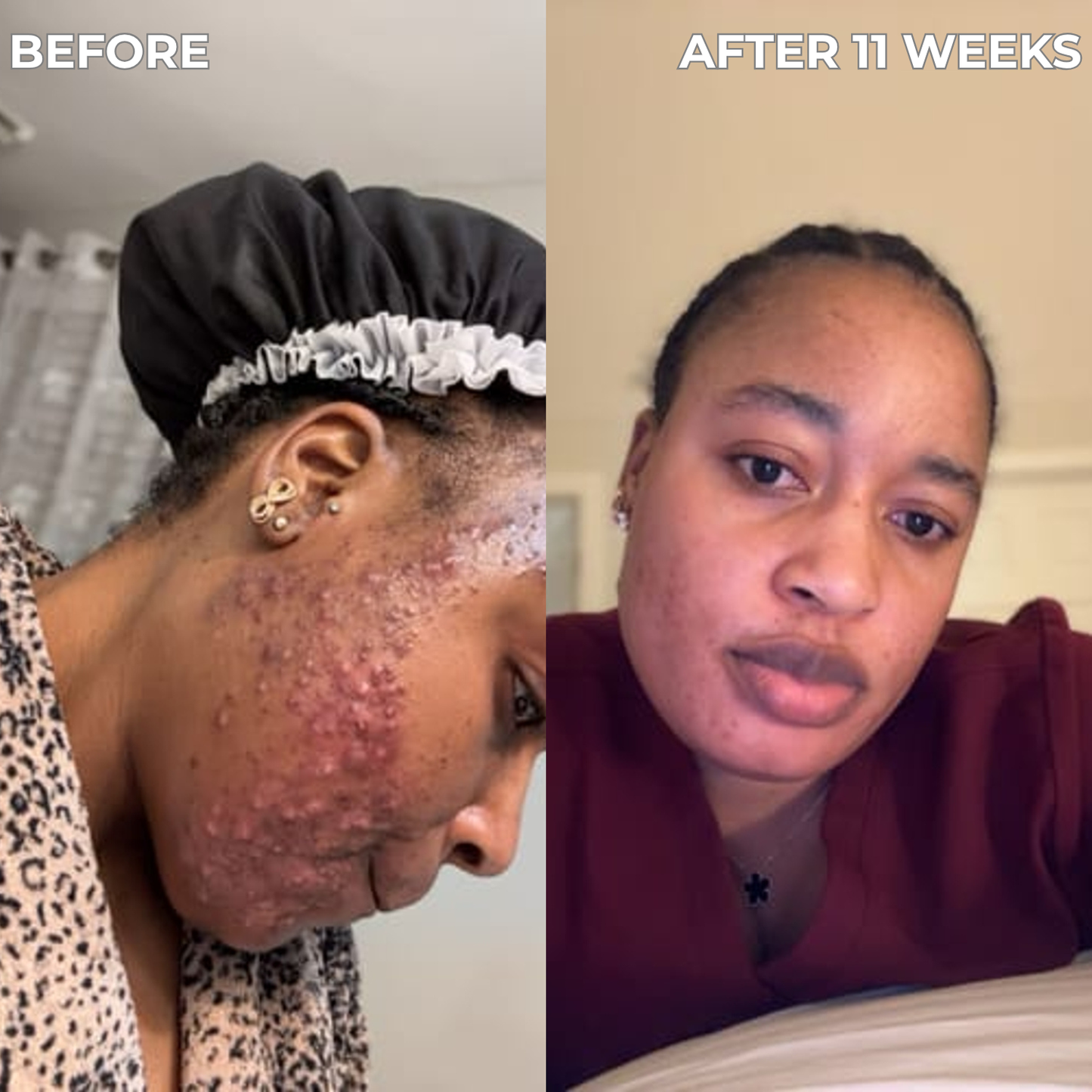 Anti-Acne & Blemish Bar.