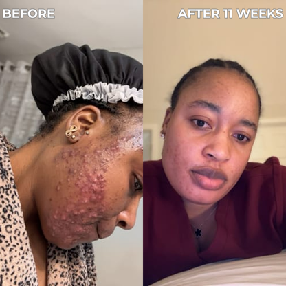 Anti-Acne & Blemish Bar.