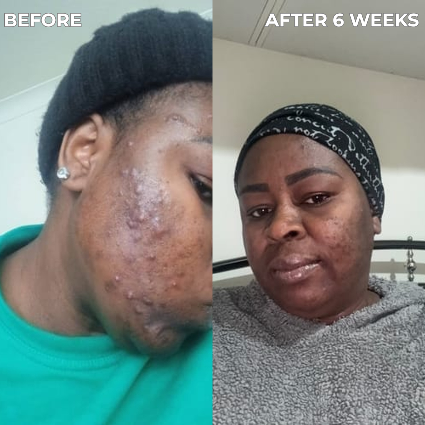 Anti-Acne & Blemish Bar.