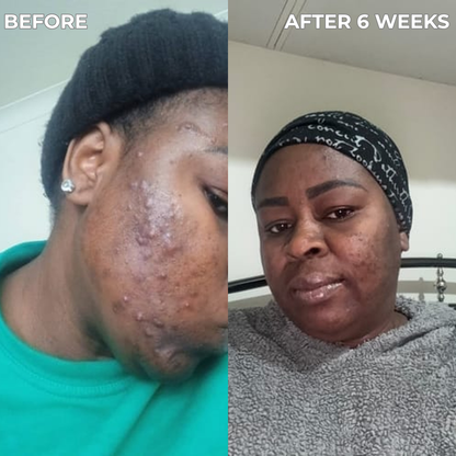 Anti-Acne & Blemish Bar.