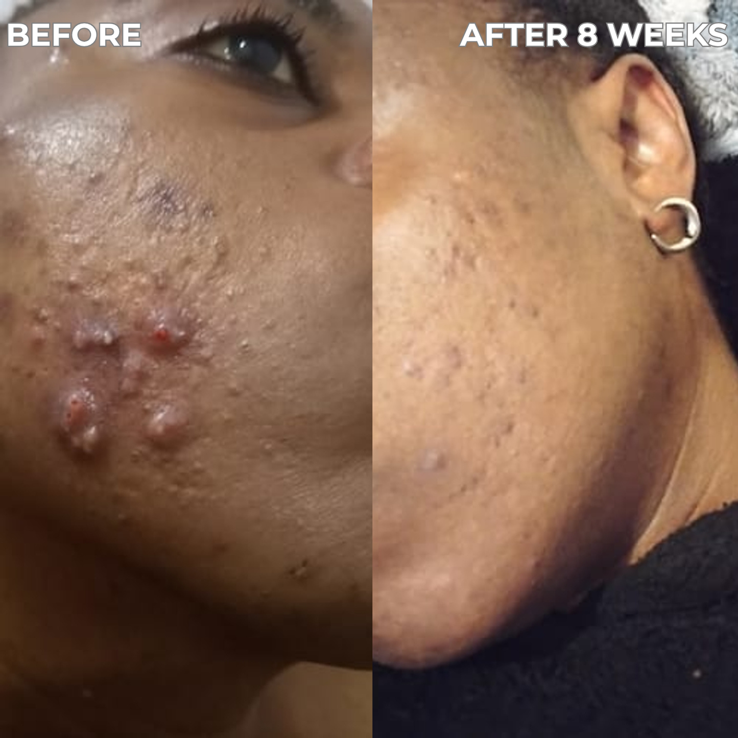 Anti-Acne & Blemish Bar.